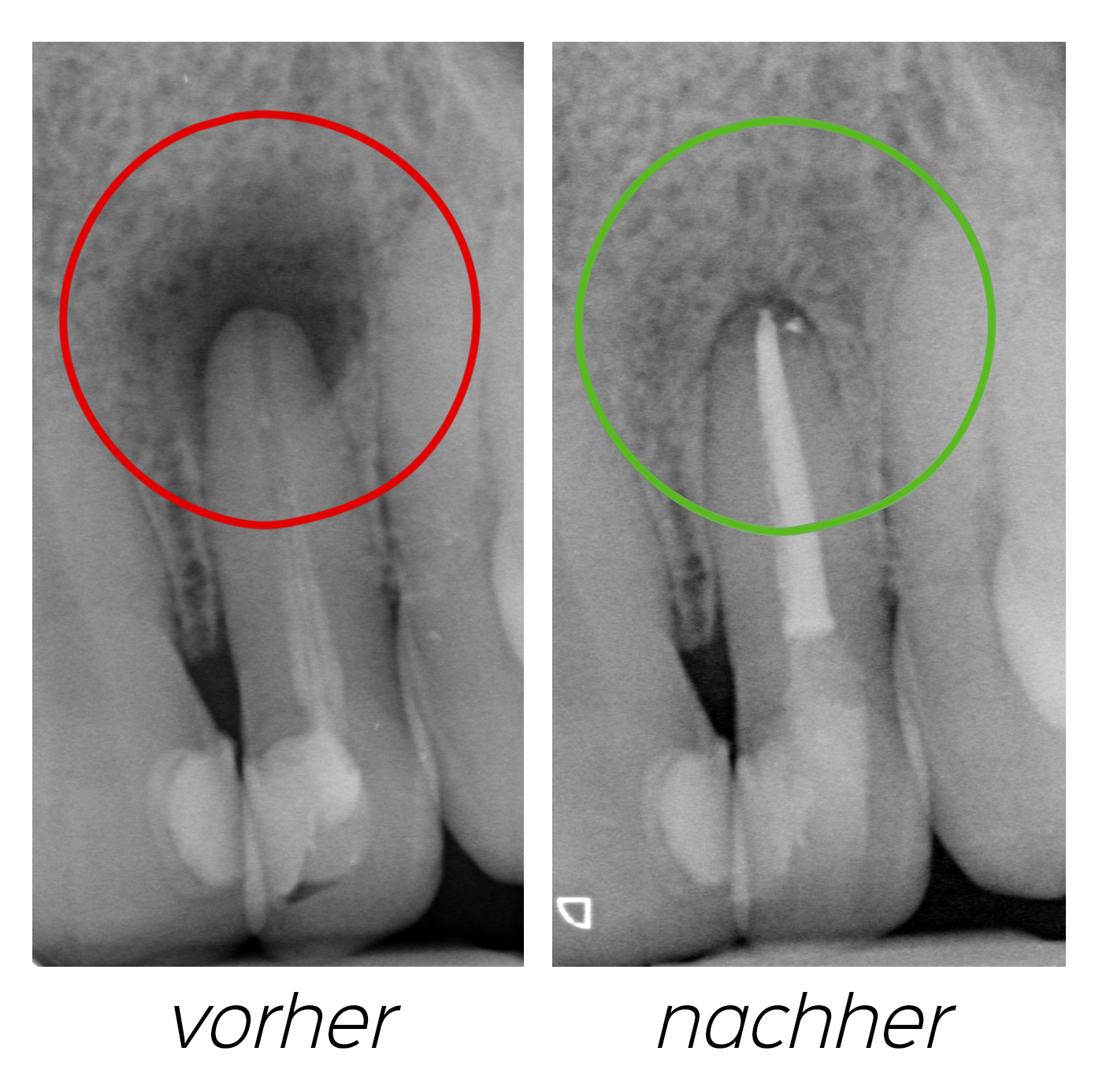 Zwei Röntgenaufnahmen eines Zahns, im Original mit vorher und nachher beschriftet